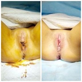 نتائج قبل وبعد عملية تجميل الشفرين في Yurchenko Plastic Surgery Team Kyiv، تصغير الشفرين
