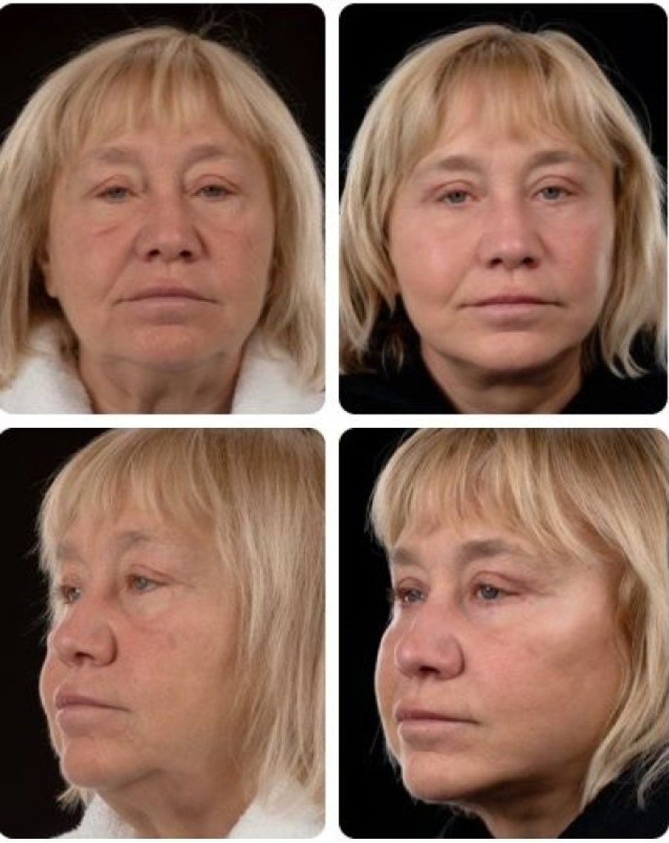 Efekty blefaroplastyki przed i po w Yurchenko Plastic Surgery Team Kyiv, korekta powiek