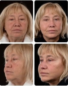 Resultados de blefaroplastia antes y después en Yurchenko Plastic Surgery Team Kyiv, corrección de párpados