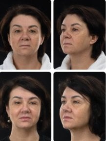 Resultados de blefaroplastia antes y después en Yurchenko Plastic Surgery Team Kyiv, corrección de párpados