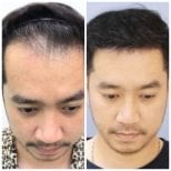 Resultados de trasplante capilar antes y después en Intrarat Hospital, línea restaurada