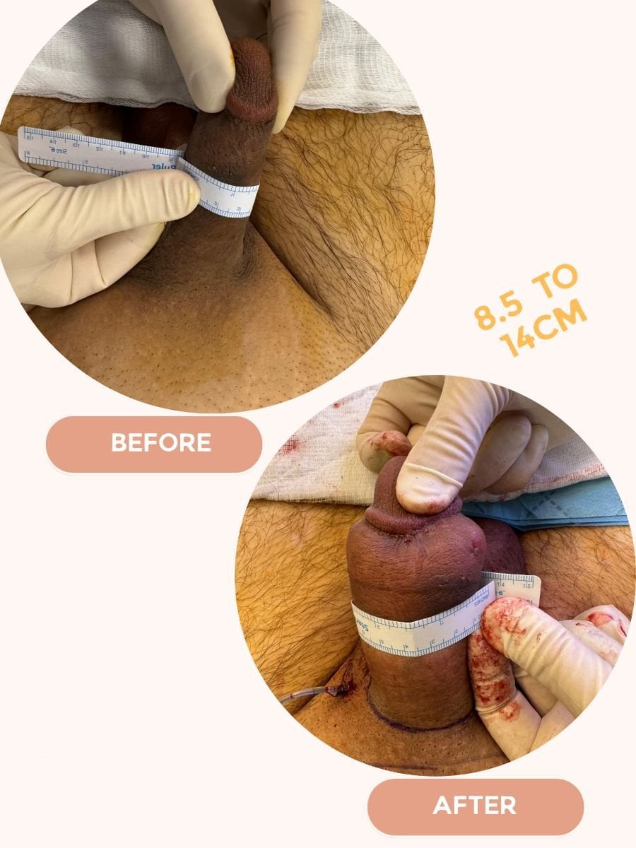 نتائج تكبير القضيب قبل وبعد في Uroaesthetic – زيادة الطول والمحيط