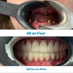 Результат до и после имплантации All-on-4 в İstinye Dental Hospital, восстановление улыбки
