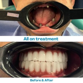 Результат до и после имплантации All-on-4 в İstinye Dental Hospital, восстановление улыбки