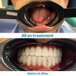 Результат до и после имплантации All-on-4 в İstinye Dental Hospital, восстановление улыбки
