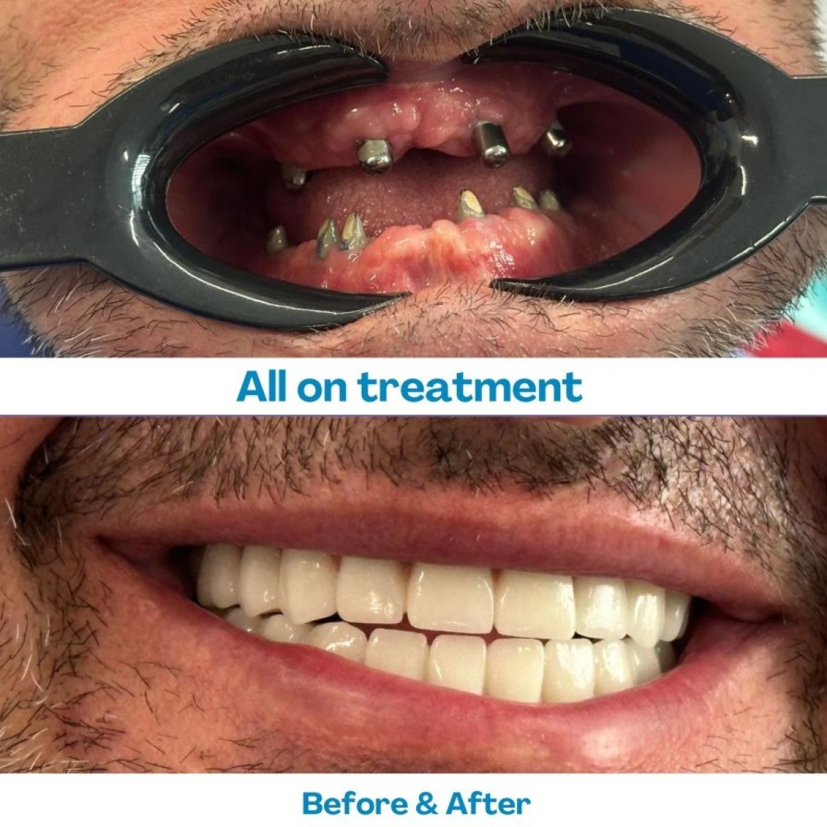 Resultados antes y después de implantes dentales All-on-6 en İstinye Dental Hospital, sonrisa restaurada