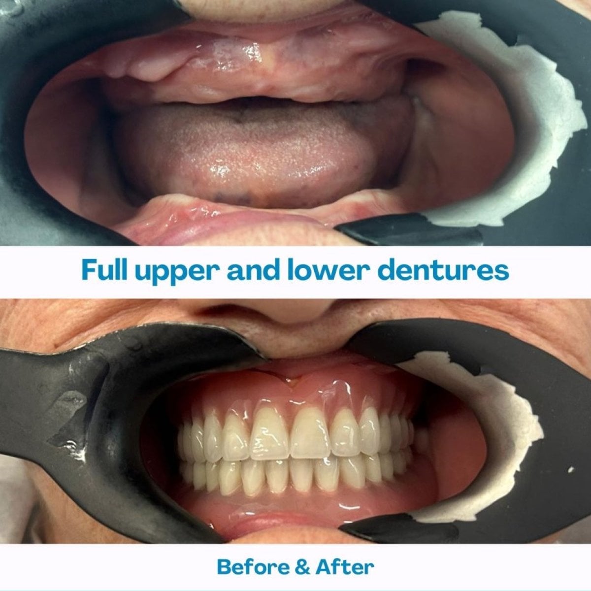 Antes y después de prótesis dentales completas en İstinye Dental Hospital, sonrisa restaurada