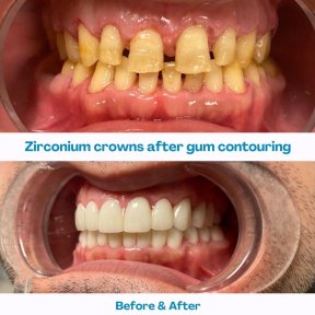 Vorher-nachher-Ergebnis: Zirkon-Kronen und Zahnfleischkonturierung bei İstinye Dental Hospital