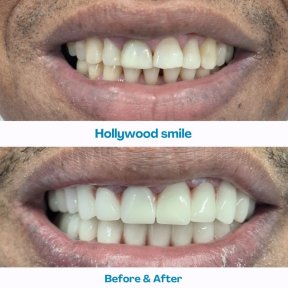 نتائج قبل وبعد ابتسامة هوليود في مستشفى İstinye Dental، تبييض الأسنان والقشور