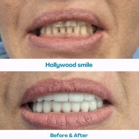 Результаты до и после Hollywood Smile в İstinye Dental Hospital, преображение улыбки винирами