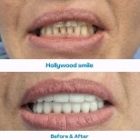 Результаты до и после Hollywood Smile в İstinye Dental Hospital, преображение улыбки винирами