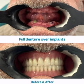 До и после установки полных протезов на имплантах в İstinye Dental Hospital, результат