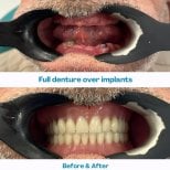 До и после установки полных протезов на имплантах в İstinye Dental Hospital, результат