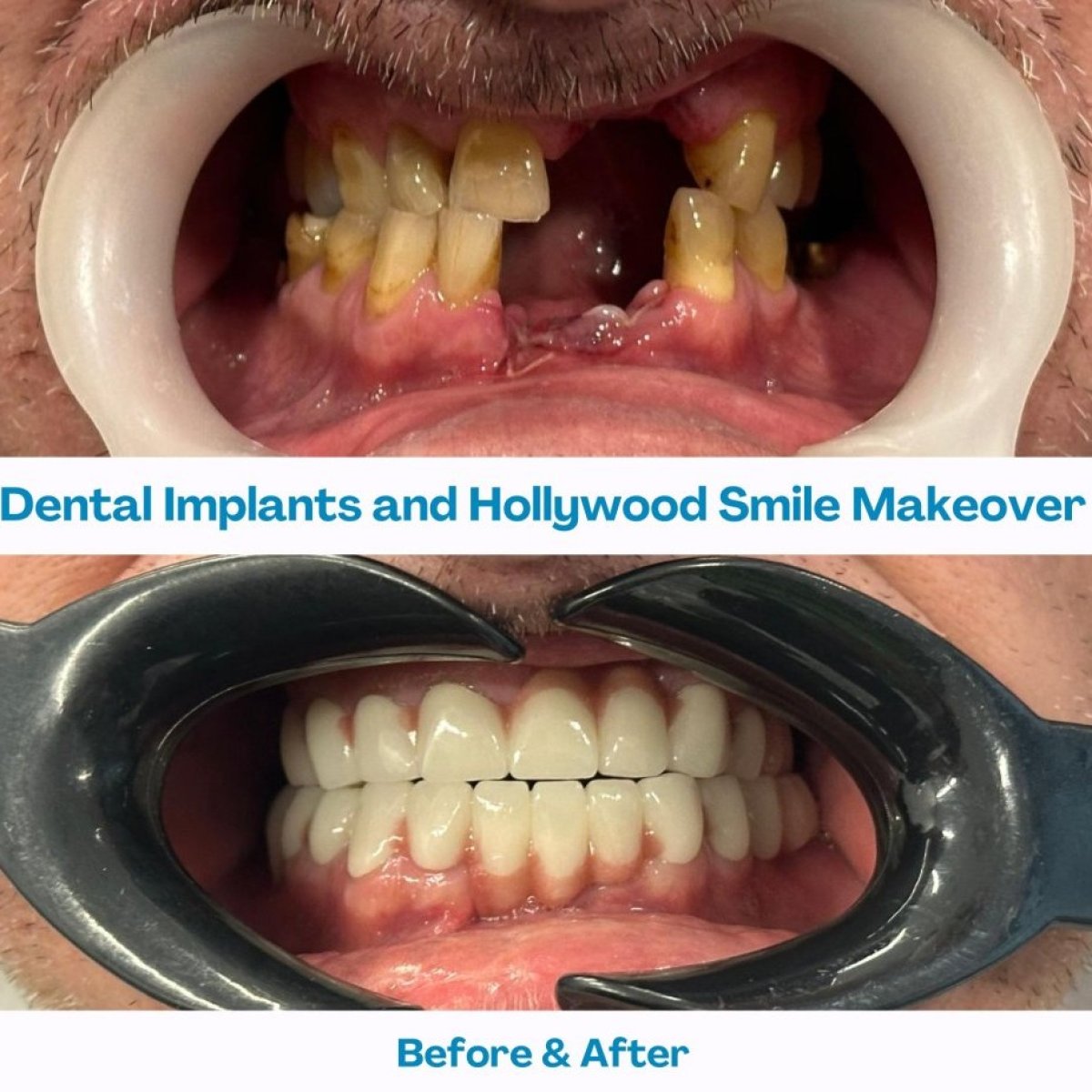Resultados antes y después de implantes dentales y Hollywood Smile en İstinye Dental Hospital