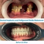 Vorher-nachher-Ergebnis Zahnimplantate und Hollywood Smile bei İstinye Dental Hospital