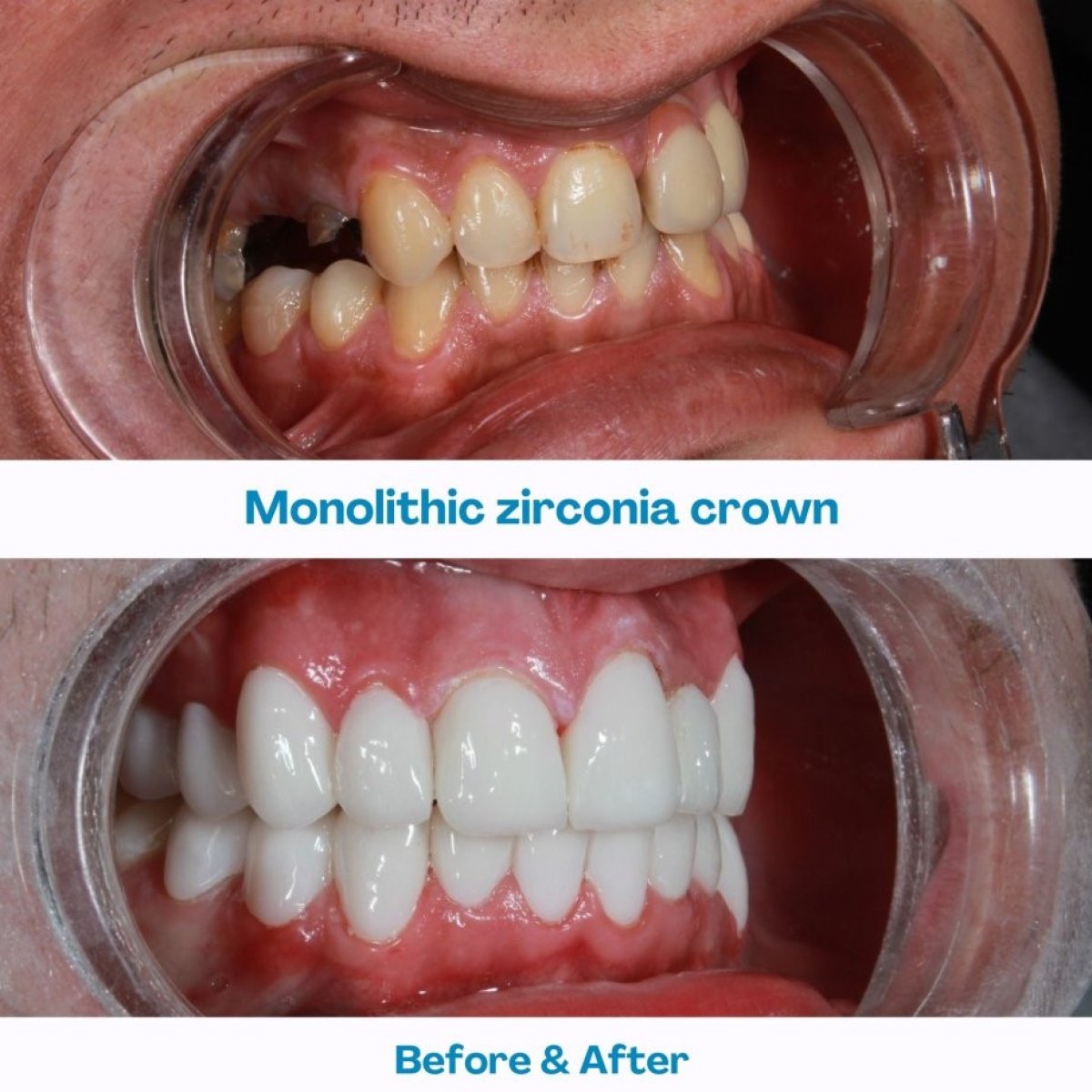 Resultados antes y después de coronas de zirconia en İstinye Dental Hospital, sonrisa mejorada
