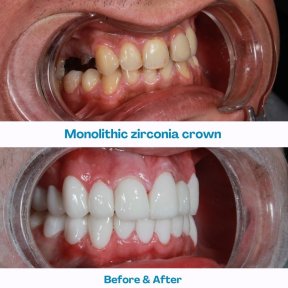 Результаты до и после установки циркониевых коронок в İstinye Dental Hospital, улучшение улыбки