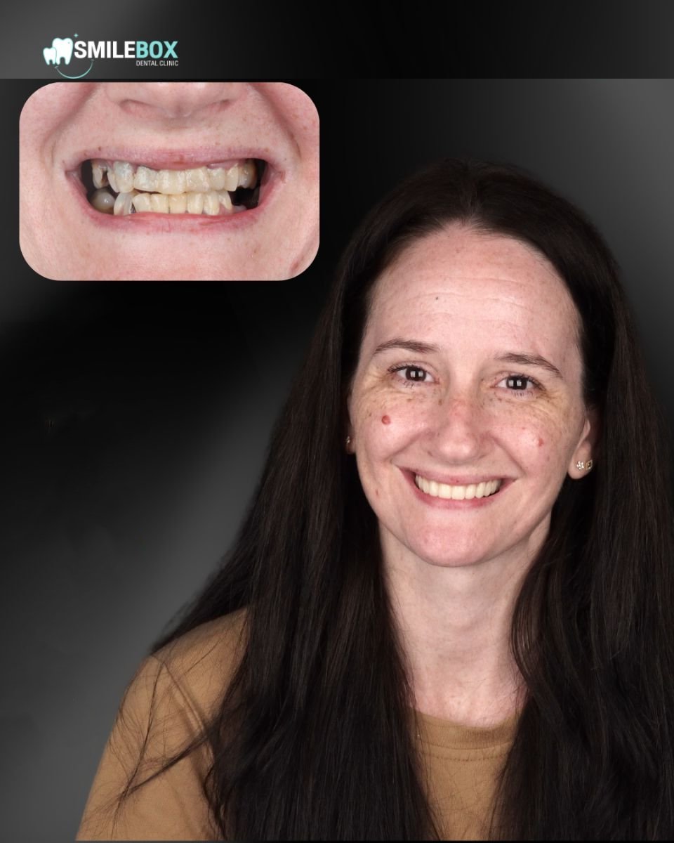 نتيجة قبل وبعد زراعة الأسنان All-on-4 في SmileBox Dental Clinic - Thonglor, Sukhumvit