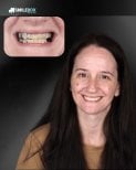 Résultat avant/après implants All-on-4 à SmileBox Dental Clinic - Thonglor, Sukhumvit