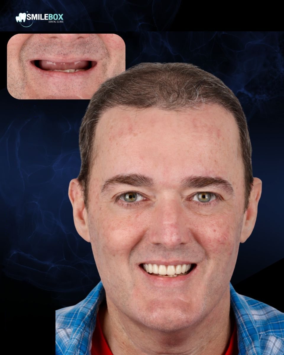 Resultado de implantes dentales All-on-4 antes y después en SmileBox Dental Clinic - Thonglor