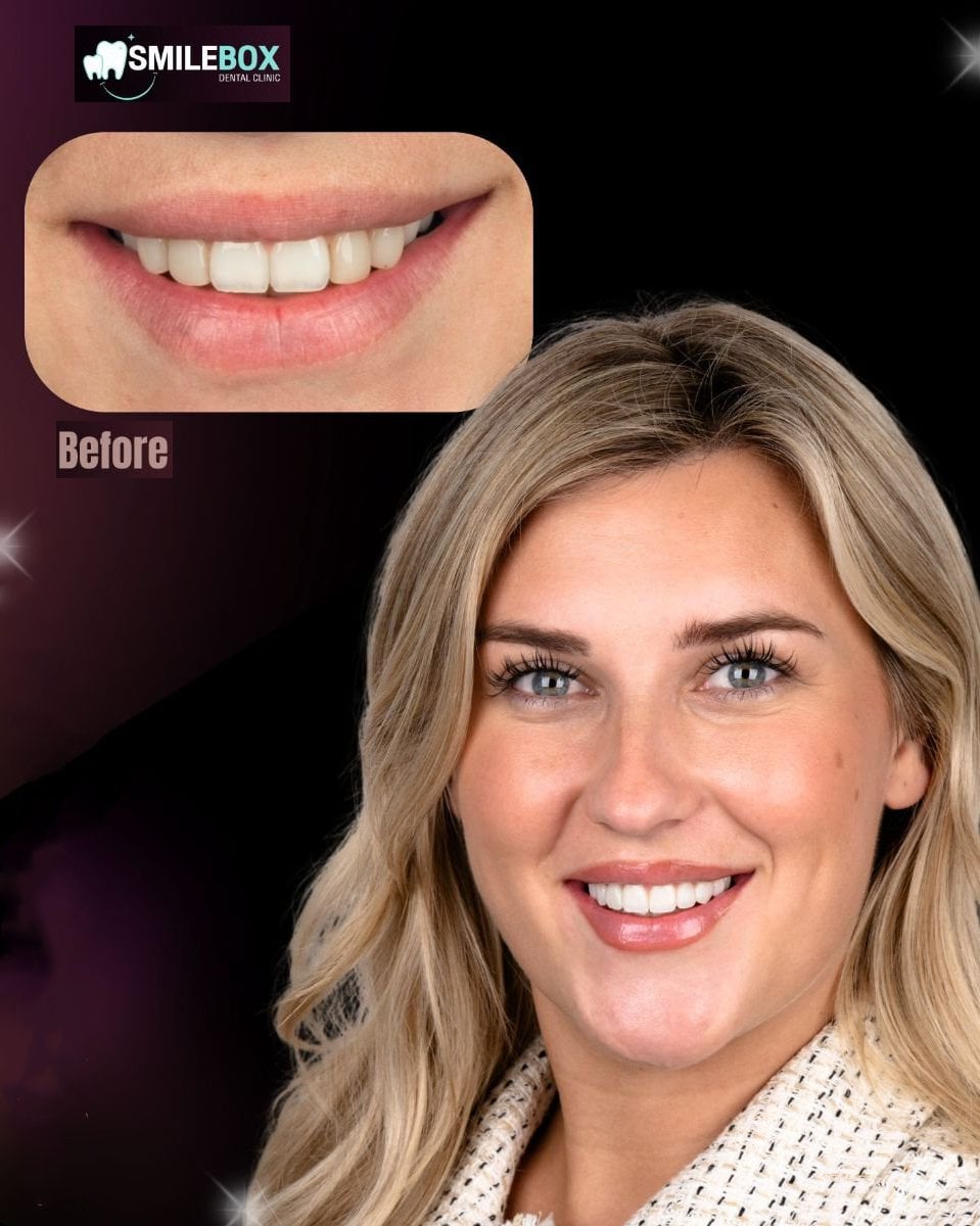 Resultados de bonding dental antes y después en SmileBox Dental Clinic - Thonglor, sonrisa mejorada