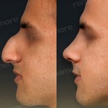 نتائج تجميل الأنف قبل وبعد في مستشفى ميموريال أنطاليا، تحسين شكل الأنف
