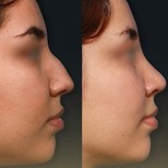 Resultados de rinoplastia antes y después en Memorial Antalya Hospital, perfil nasal mejorado
