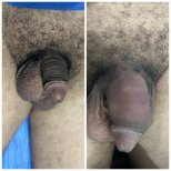 Vorher-nachher-Ergebnisse Penisvergrößerung bei Cairo Plastic Clinic, sichtbare Größenzunahme