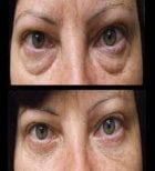 Blepharoplasty before and after results at Odontoliuzzi Dentistry and Health, eyelid correction