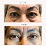 Blepharoplasty before and after results at Odontoliuzzi Dentistry and Health, eyelid correction