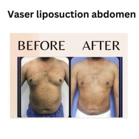 Before and after Vaser liposuction abdomen results at ID Clinic Bangkok, visible fat reduction