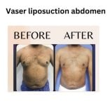 Before and after Vaser liposuction abdomen results at ID Clinic Bangkok, visible fat reduction