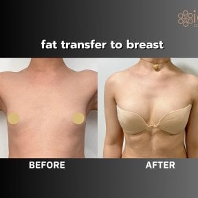 Before and after fat transfer to breast at ID Clinic Bangkok, natural breast augmentation result