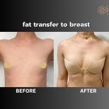 Before and after fat transfer to breast at ID Clinic Bangkok, natural breast augmentation result