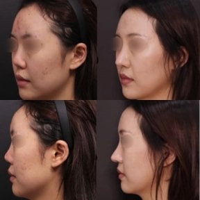 Before and after rhinoplasty results at VG Plastic Surgery, improved nose shape and profile