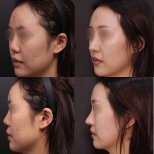 Before and after rhinoplasty results at VG Plastic Surgery, improved nose shape and profile