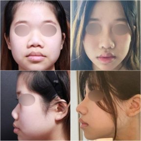 Before and after rhinoplasty results at VG Plastic Surgery, nose reshaping and profile improvement