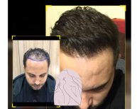 Before and after hair transplant result at Dr. MED – restored hairline and fuller hair