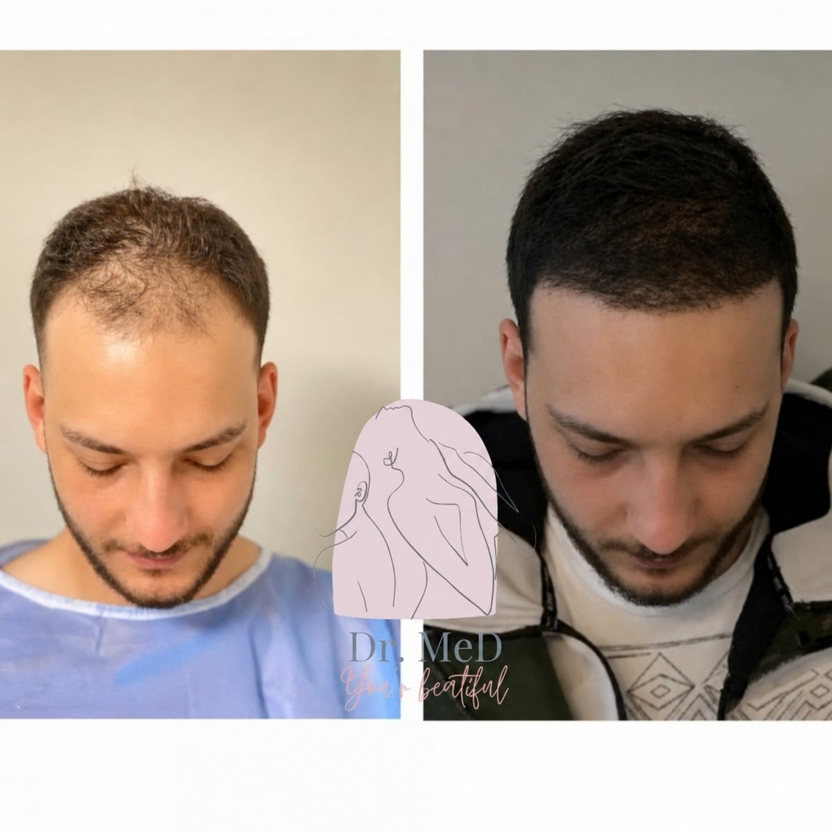 نتائج زراعة الشعر قبل وبعد في Dr. MED – استعادة خط الشعر وكثافة أكبر