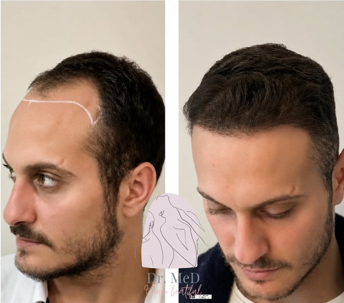 نتيجة زراعة الشعر قبل وبعد في Dr. MED – استعادة خط الشعر وكثافة الشعر