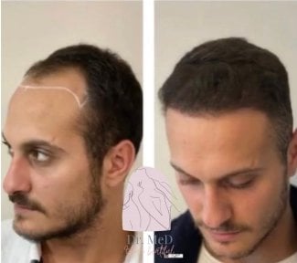 Результат пересадки волос до и после в Dr. MED – восстановленная линия роста волос