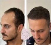 Результат пересадки волос до и после в Dr. MED – восстановленная линия роста волос