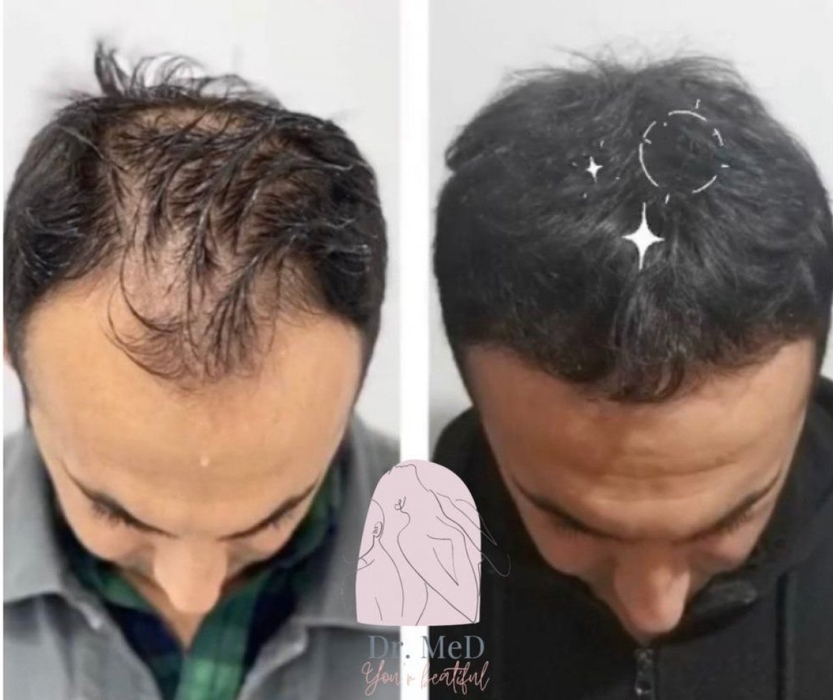 Résultat greffe de cheveux avant/après chez Dr. MED – densité restaurée chez homme