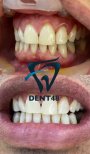 Before and after tooth whitening results at Dent48 Oral and Dental Health Polyclinics