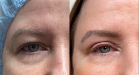 Before and after blepharoplasty results at Altos Clinic – eyelid correction for youthful look