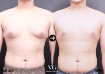 Vorher-nachher-Ergebnis Gynäkomastie-OP bei VG Plastic Surgery, männliche Brustkorrektur