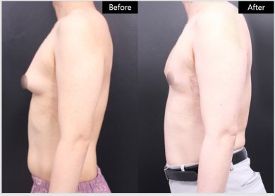 Vorher-nachher-Ergebnis Gynäkomastie-OP bei VG Plastic Surgery – flachere Männerbrust