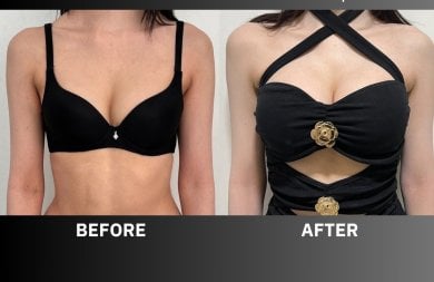 Before and after breast augmentation results at ID Clinic Bangkok, enhanced breast volume