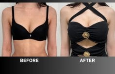 Before and after breast augmentation results at ID Clinic Bangkok, enhanced breast volume