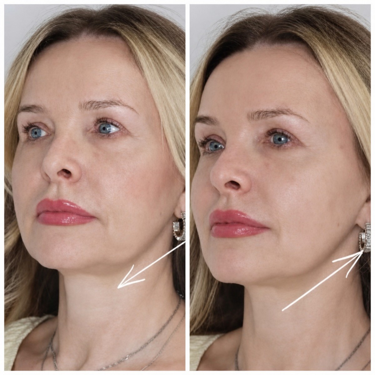 Resultados de lifting facial antes y después en Altos Clinic, mejora visible de mandíbula y cuello